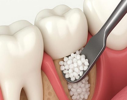 Bone Grafting: What it is, When to Do It, and Risks or Side Effects. 