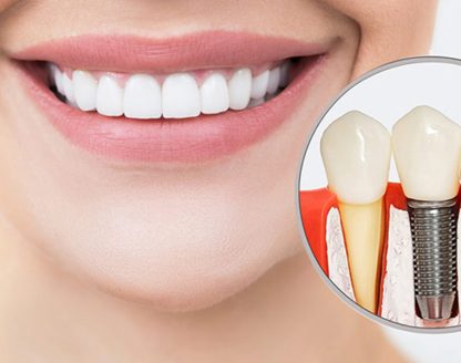 Get a Snappy Smile with Dental Implants 