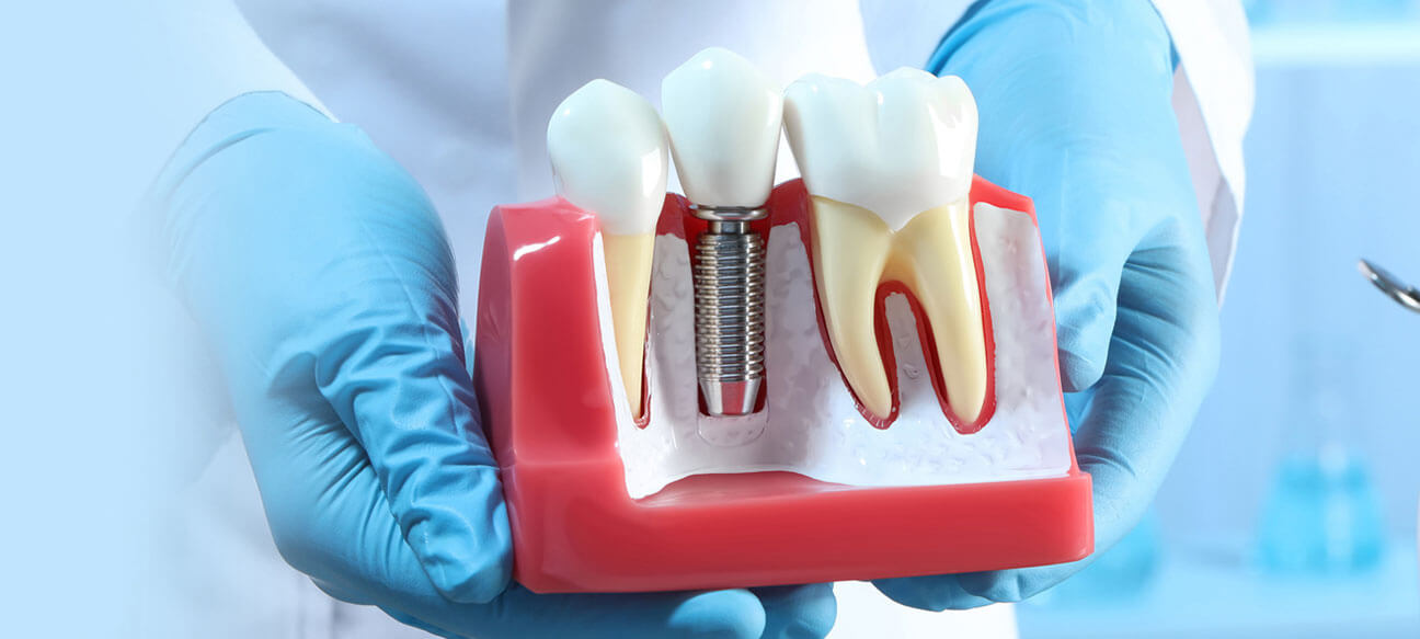 All-on-Four-Dental-Implants-1