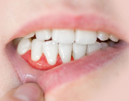 Periodontics Uncovered: Your Comprehensive Resource for Healthy Gums 