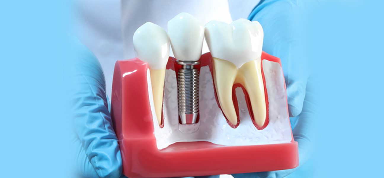 Dental Implants vs. Dentures: Which Option is Right for You?