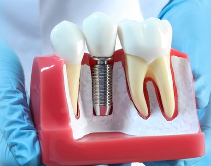 Dental Implants vs. Dentures: Which Option is Right for You? 