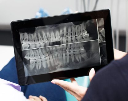 3D-X-Rays and Early Detection: A Game-Changer in Preventive Dentistry 