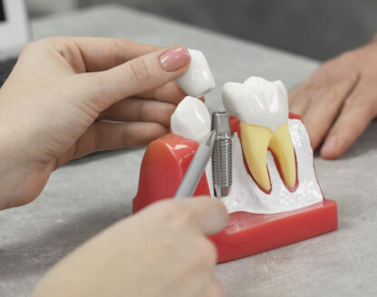 Things You Should Know About Dental Implant Placement 