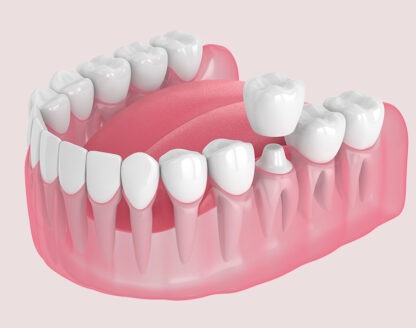 5 Ways a Dental Crown Improves Your Overall Oral Health 