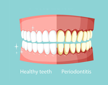 Understanding the Differences Between Prophy and Perio Maintenance 