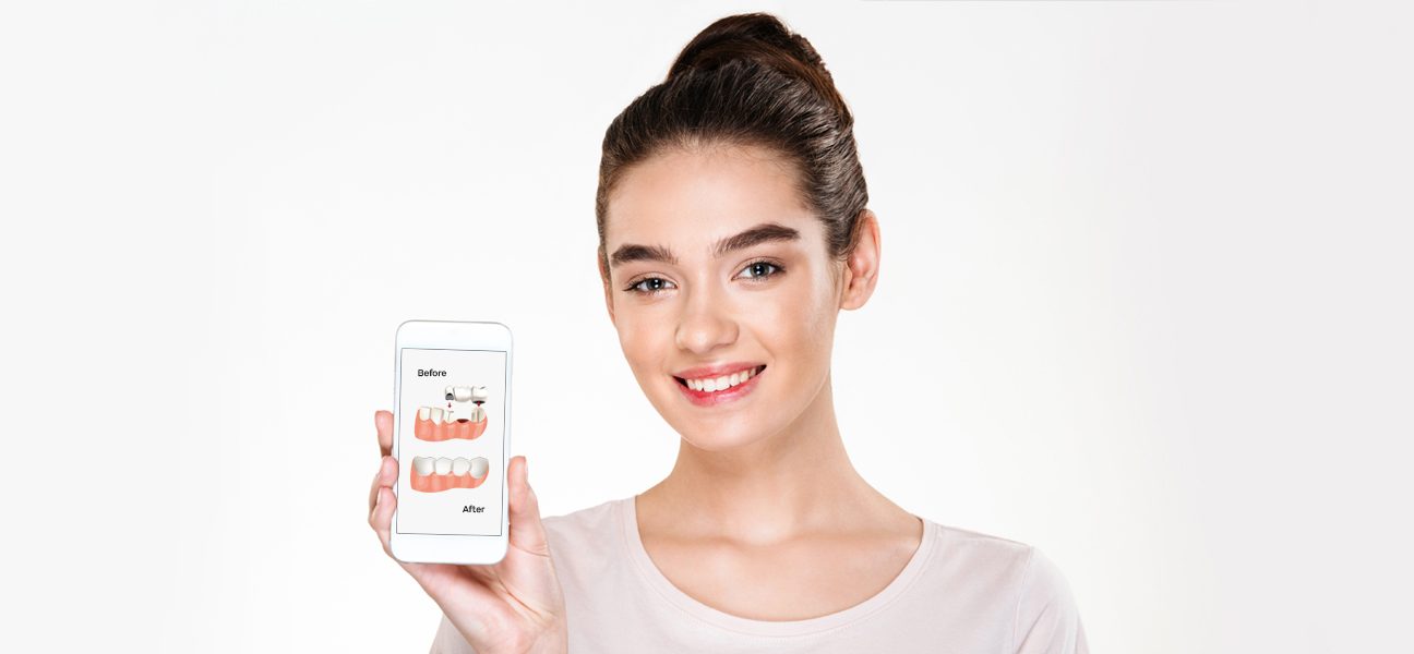 The Importance of Replacing Missing Teeth With Dental Bridges