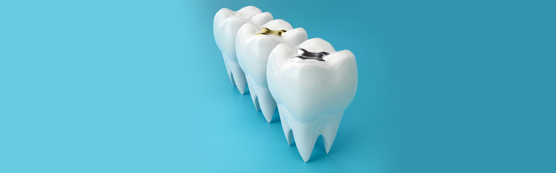Dental Fillings for Front Teeth vs. Back Teeth